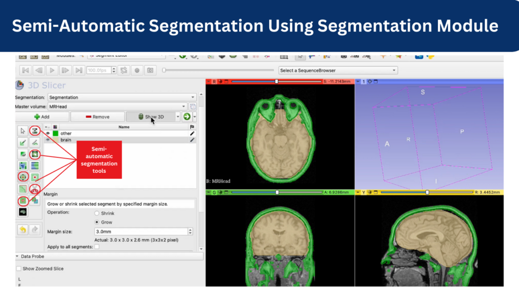 Semi-Automatic Segmentation Using Segmentation Module